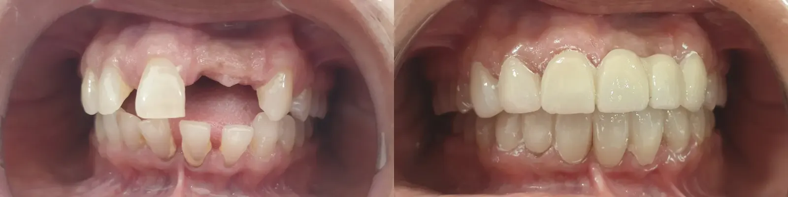Smile Makeover — after treatment
