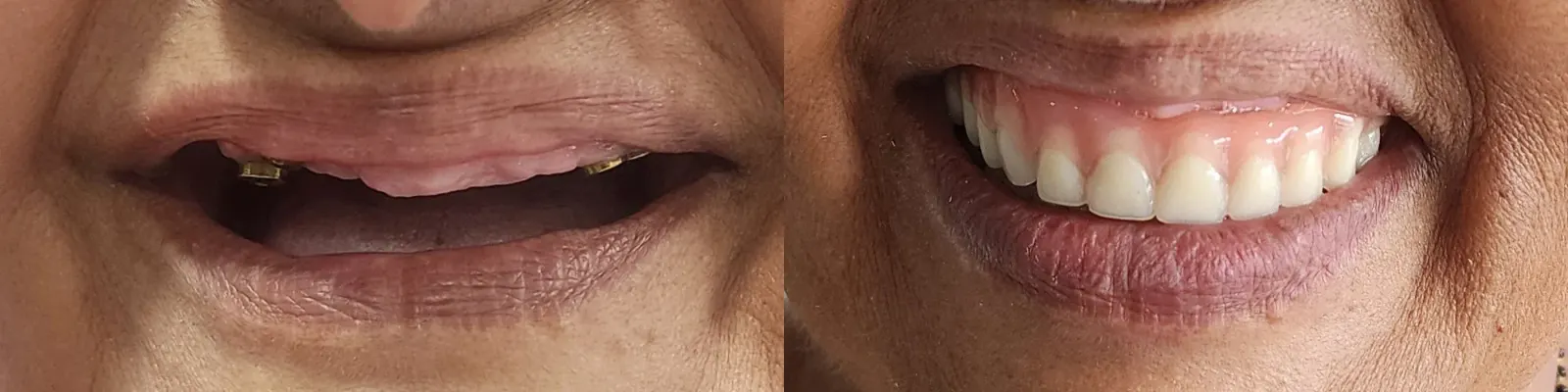 Full Mouth Implant Rehabilitation — after treatment