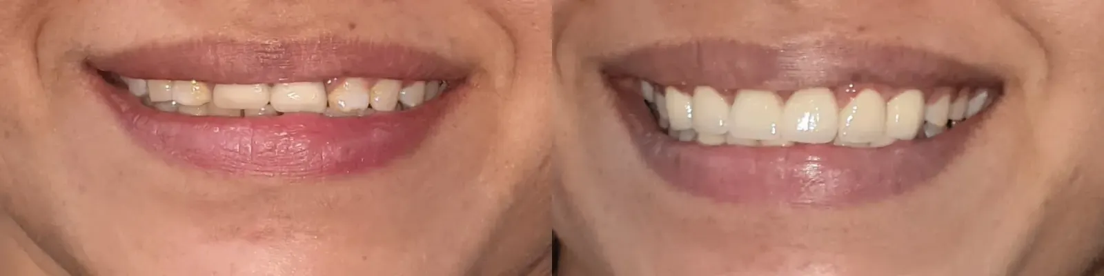 Smile Makeover — after treatment