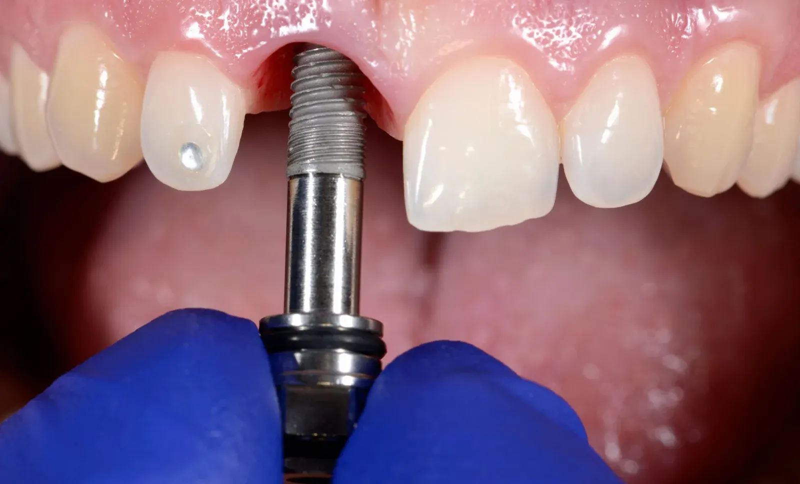 Dental Implants & Tooth Replacement